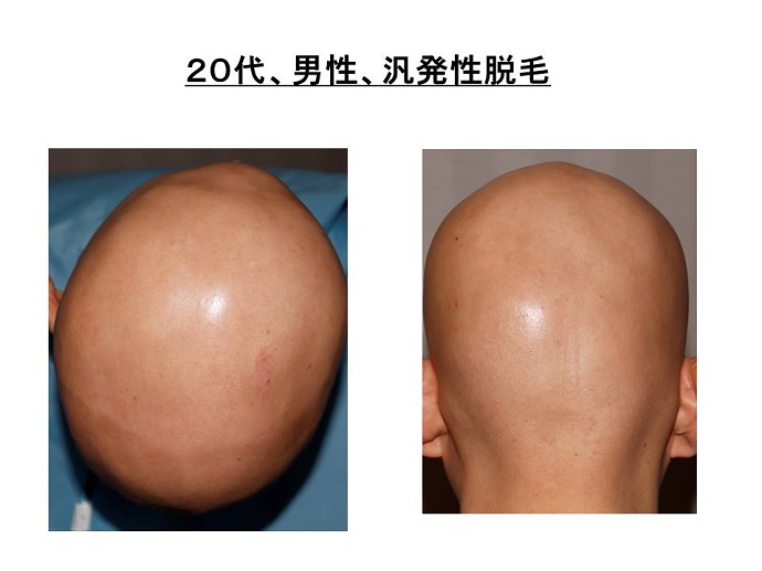 円形脱毛症　病院